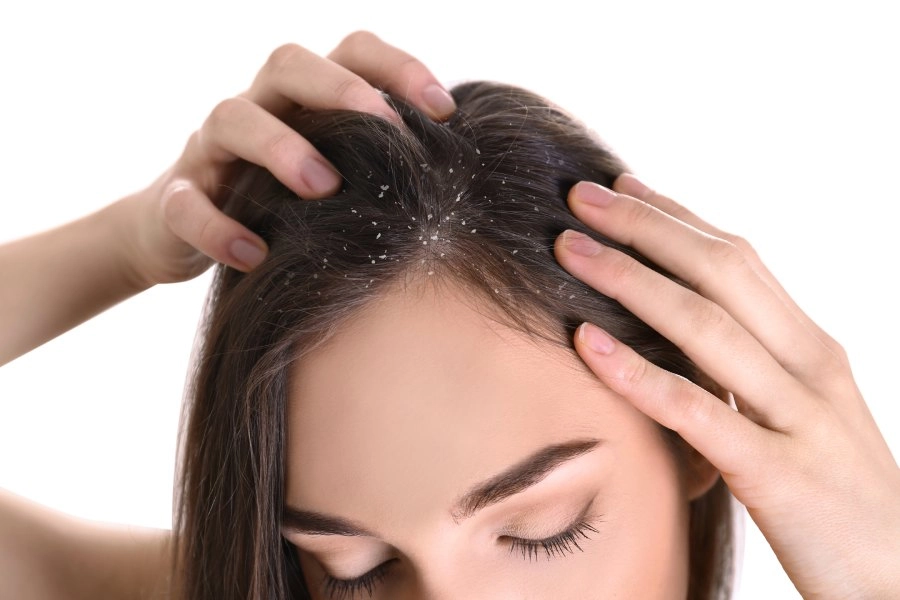 Aprenda como usar shampoo anticaspa e tire esse problema da sua cabeça!