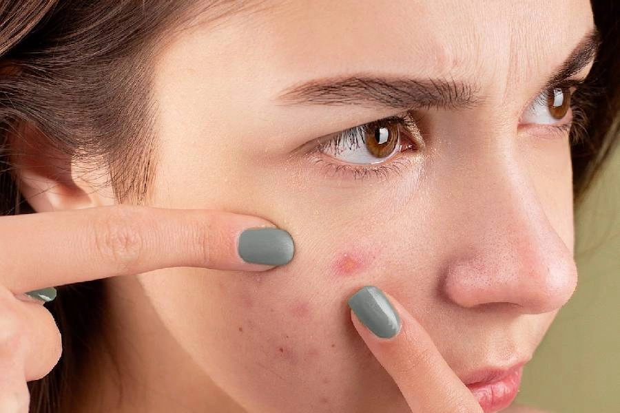 Como tirar manchas de acne do rosto? Conheça as 6 melhores alternativas
