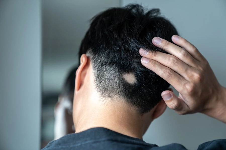 Descubra o que causa a queda de cabelo masculino e como tratar