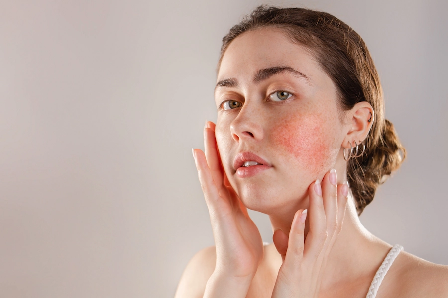 O que é a rosácea? Aprenda como amenizar essa condição com 3 dicas de skincare