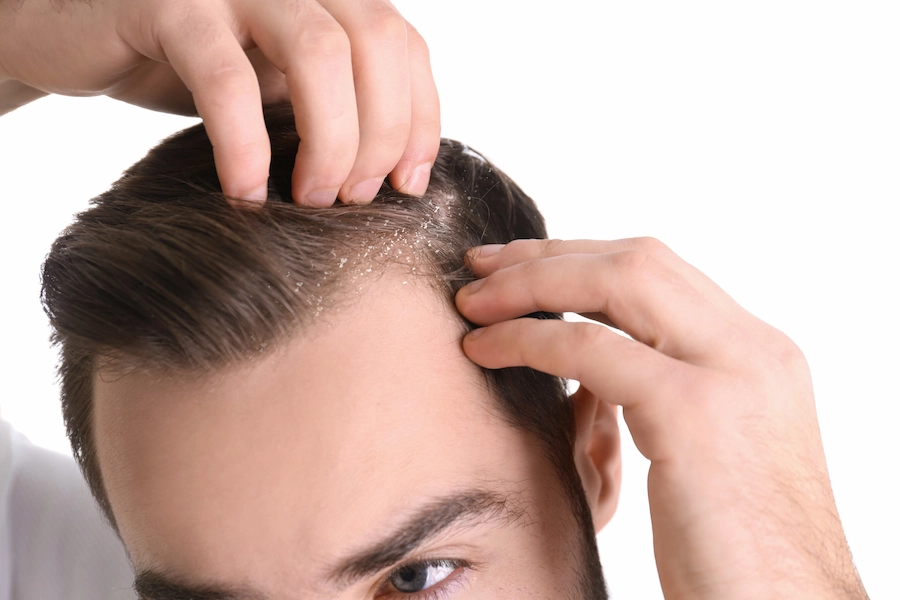 Como tirar a caspa do cabelo? Aprenda as 3 melhores soluções para controlá-la